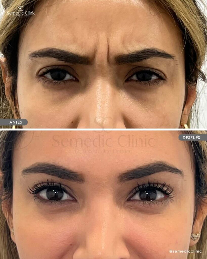 Antes y después de tratamiento con toxina botulínica en frente y patas de gallo en Semedic Clinic Madrid. Resultados naturales y sin pérdida de expresión facial.