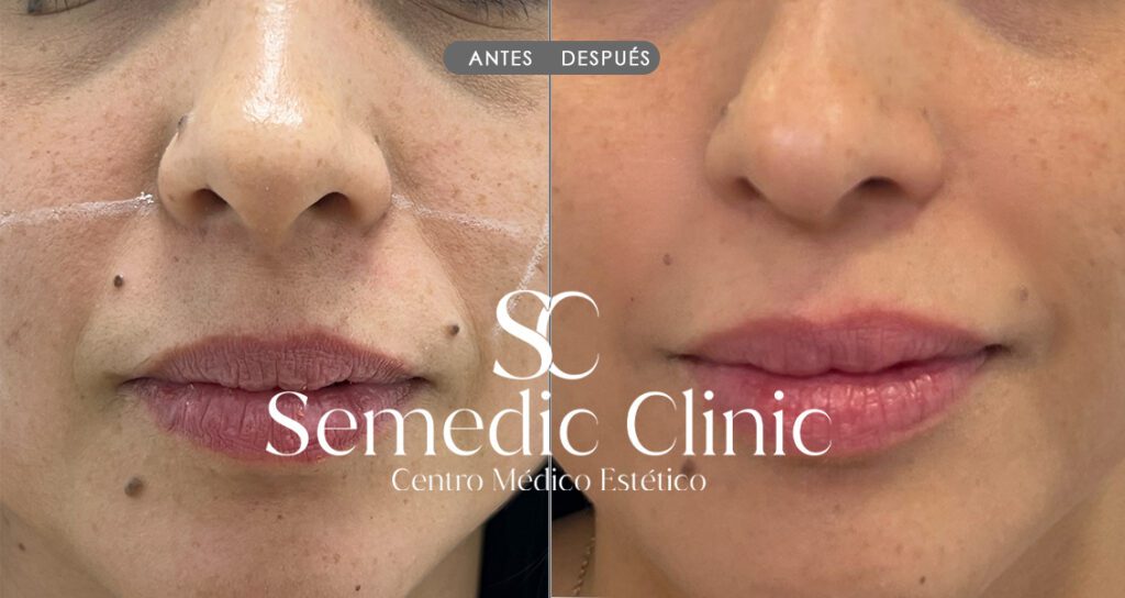 Antes del aumento de labios con ácido hialurónico, labios naturales sin volumen ni definición.