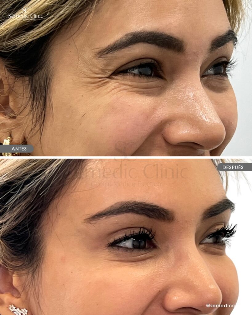 Antes y después de tratamiento con toxina botulínica en frente y patas de gallo en Semedic Clinic Madrid. Resultados naturales y sin pérdida de expresión facial.