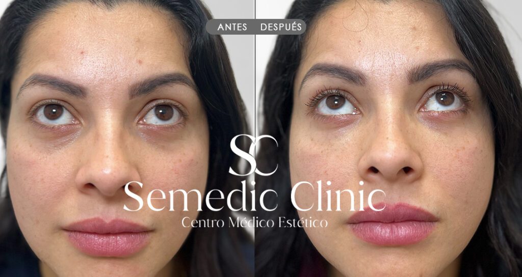 Antes del relleno de ojeras con ácido hialurónico, se observan hundimiento y sombras oscuras debajo de los ojos.