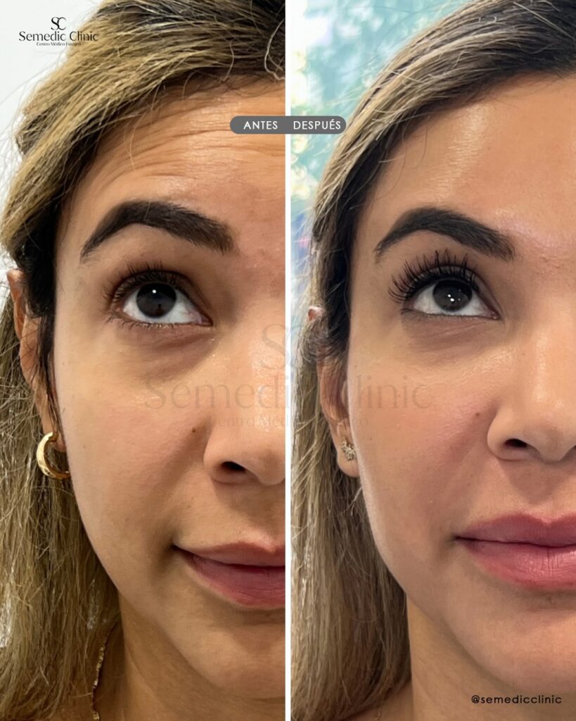 Antes y después de tratamiento con toxina botulínica en frente y patas de gallo en Semedic Clinic Madrid. Resultados naturales y sin pérdida de expresión facial.