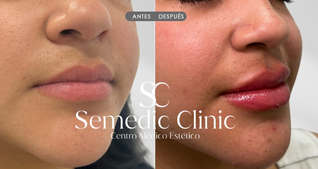 Antes del aumento de labios con ácido hialurónico, labios naturales sin volumen ni definición.