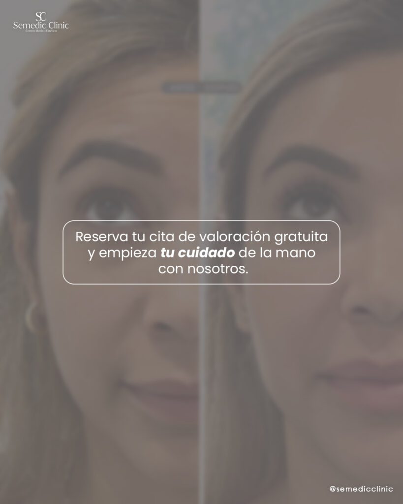 Antes y después de tratamiento con toxina botulínica en frente y patas de gallo en Semedic Clinic Madrid. Resultados naturales y sin pérdida de expresión facial.
