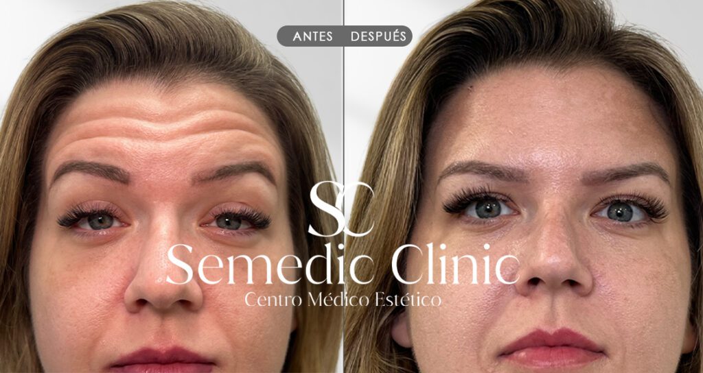 Resultados de neuromoduladores en la frente – Semedic Clinic
