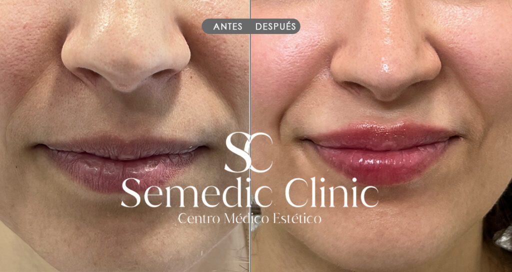 Antes del aumento de labios con ácido hialurónico, labios naturales sin volumen ni definición.