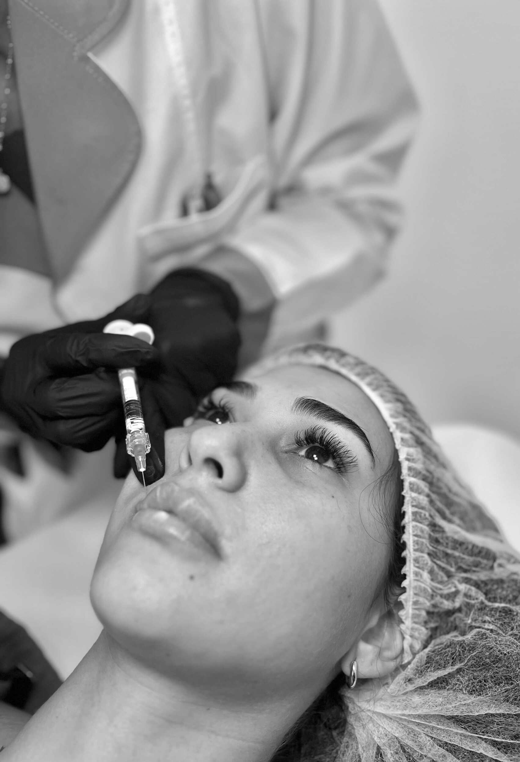 Aplicación de ácido hialurónico en labios en Semedic Clinic, Madrid