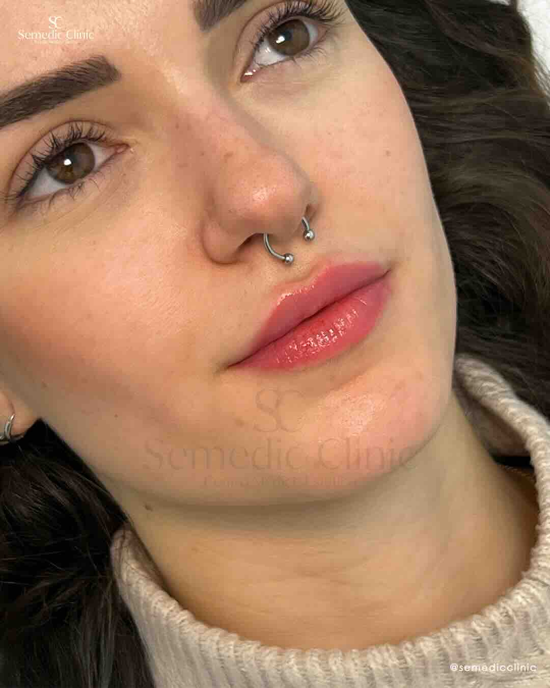 Mujer con labios hidratados y voluminosos tras tratamiento de ácido hialurónico