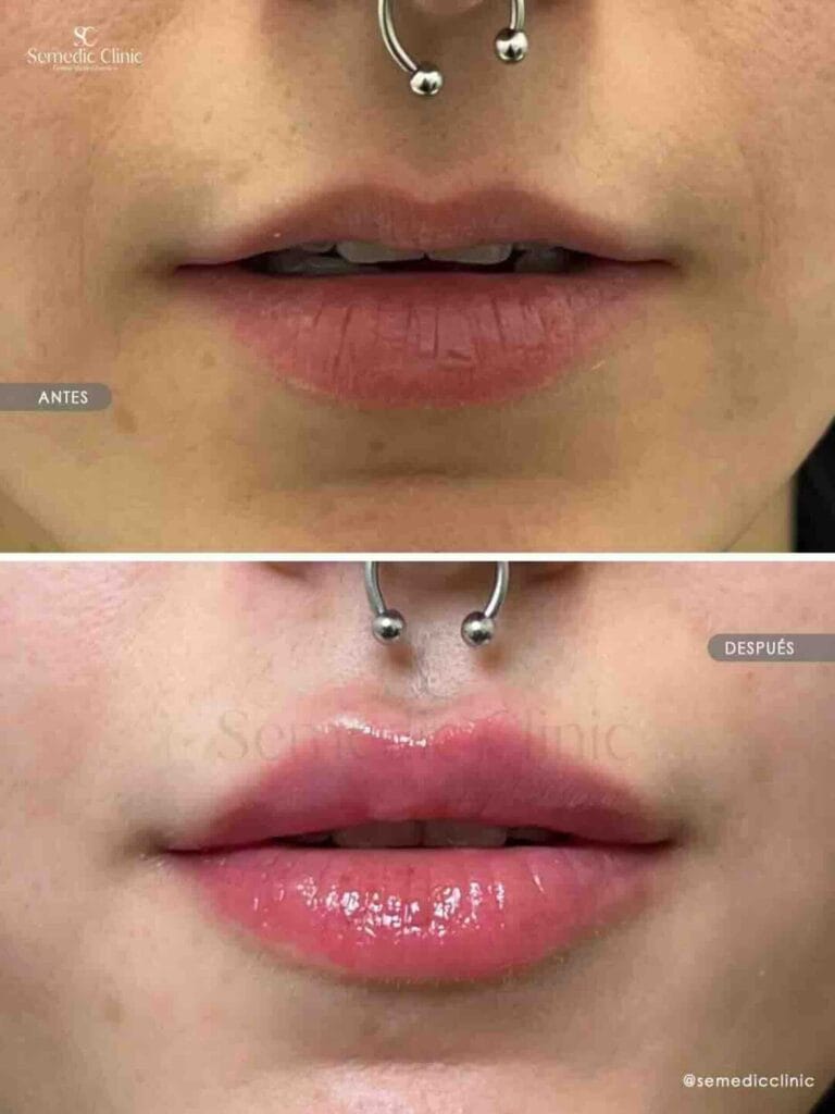 Antes y después de aumento de labios con ácido hialurónico en Semedic Clinic Madrid, resultado natural con más volumen, hidratación y definición labial.