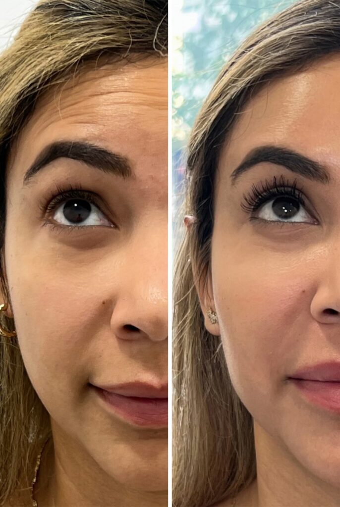 Antes y después de neuromoduladores en la frente para suavizar arrugas de expresión